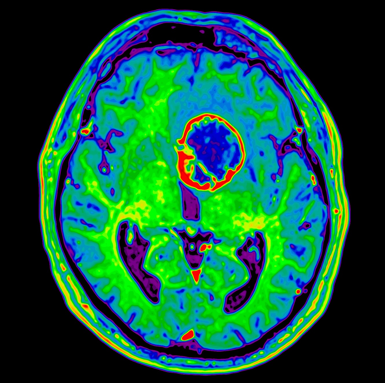 rCBV perfusion map of the same ring-enhancing lesion