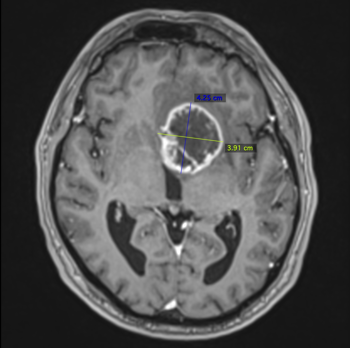 T1 post-contrast MRI with RANO bidimensional calipers (4.25 × 3.91 cm)