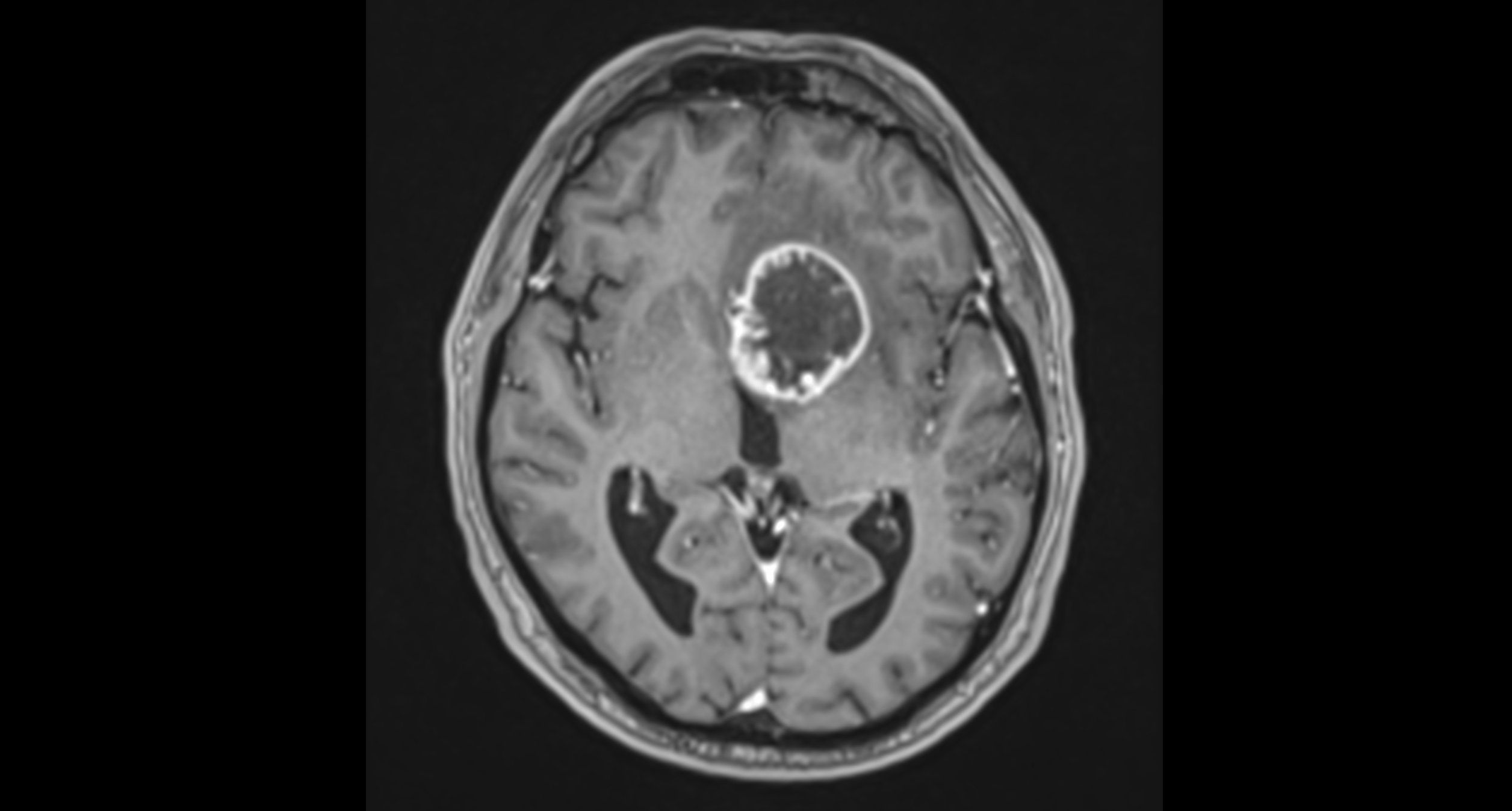 T1 post-contrast MRI