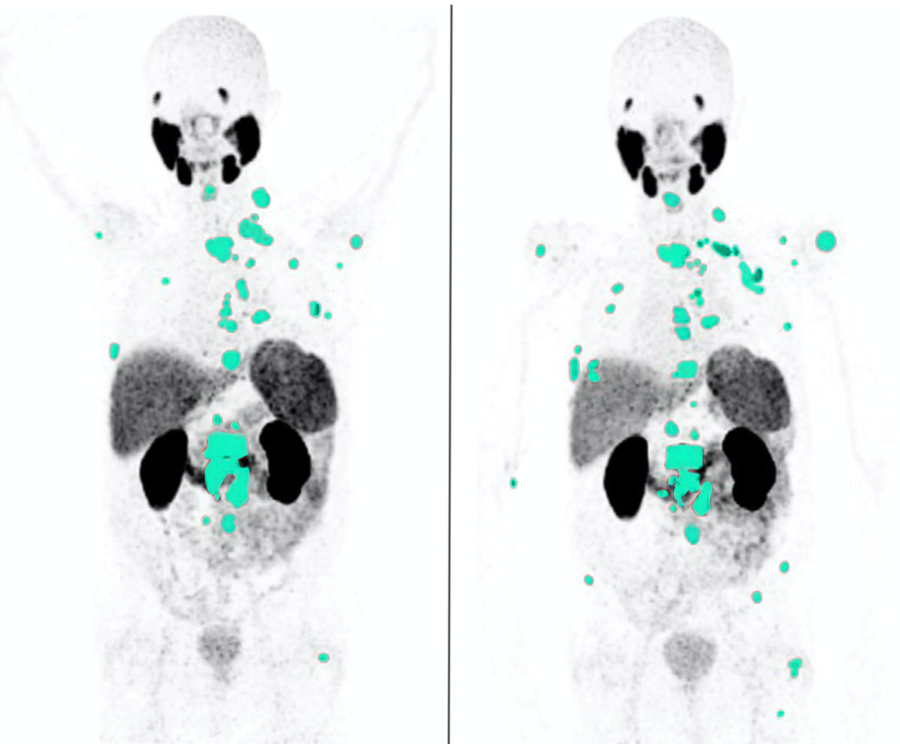 PSMA PET/CT — segmented MTV (PSMA-VOL annotation)