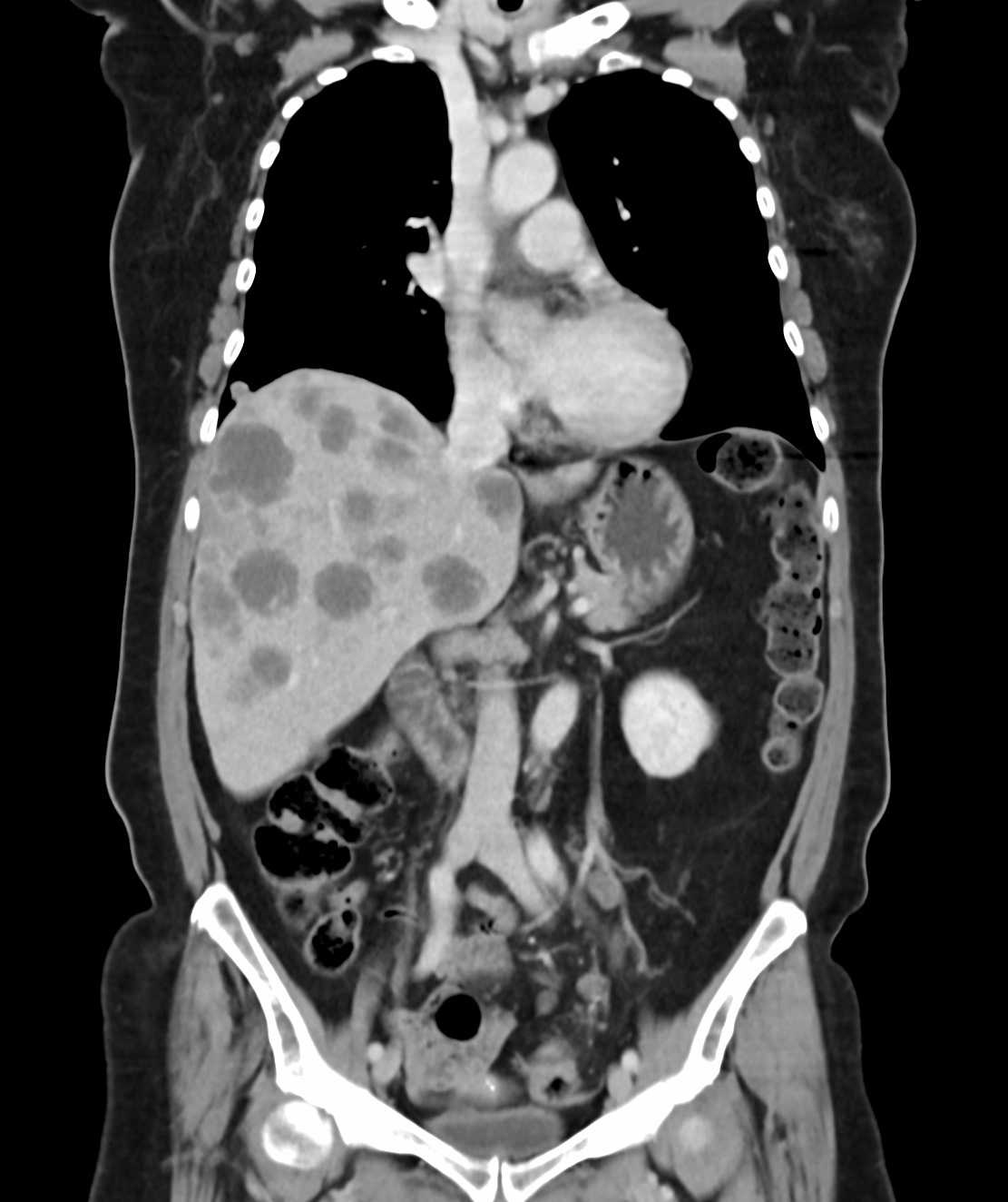 CE CT portal venous phase — raw acquisition