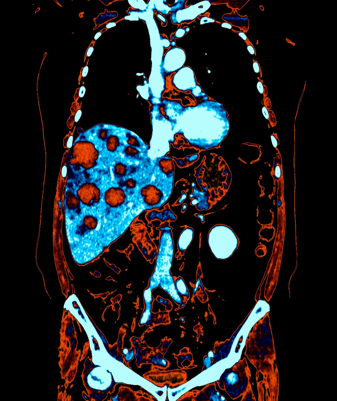 Organ-specific lesion tracking — segmented