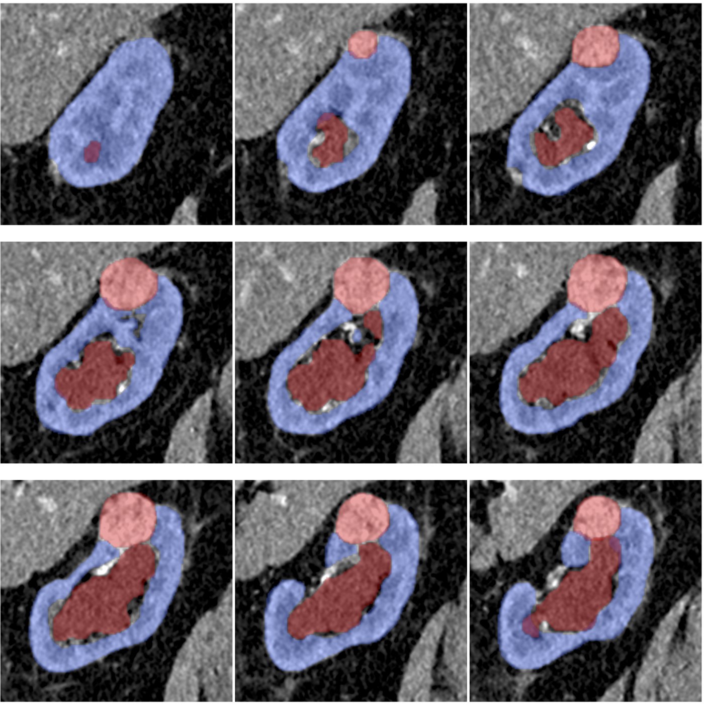 Renal tumor 3D volumetric segmentation — sagittal view