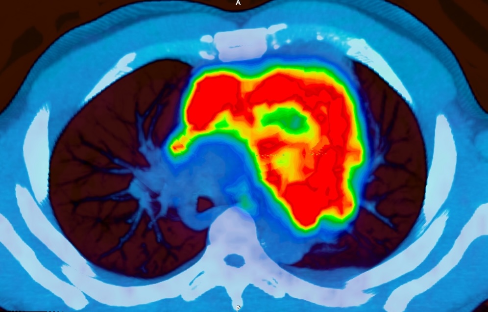EoT axial PET/CT